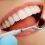 All You Need To Know About Porcelain Veneers