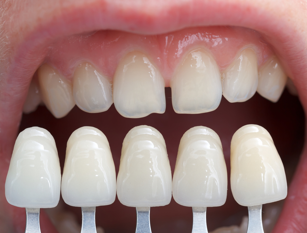 What Is The Cost Of Porcelain Veneers - Smiles On Queen Dentist Nobleton