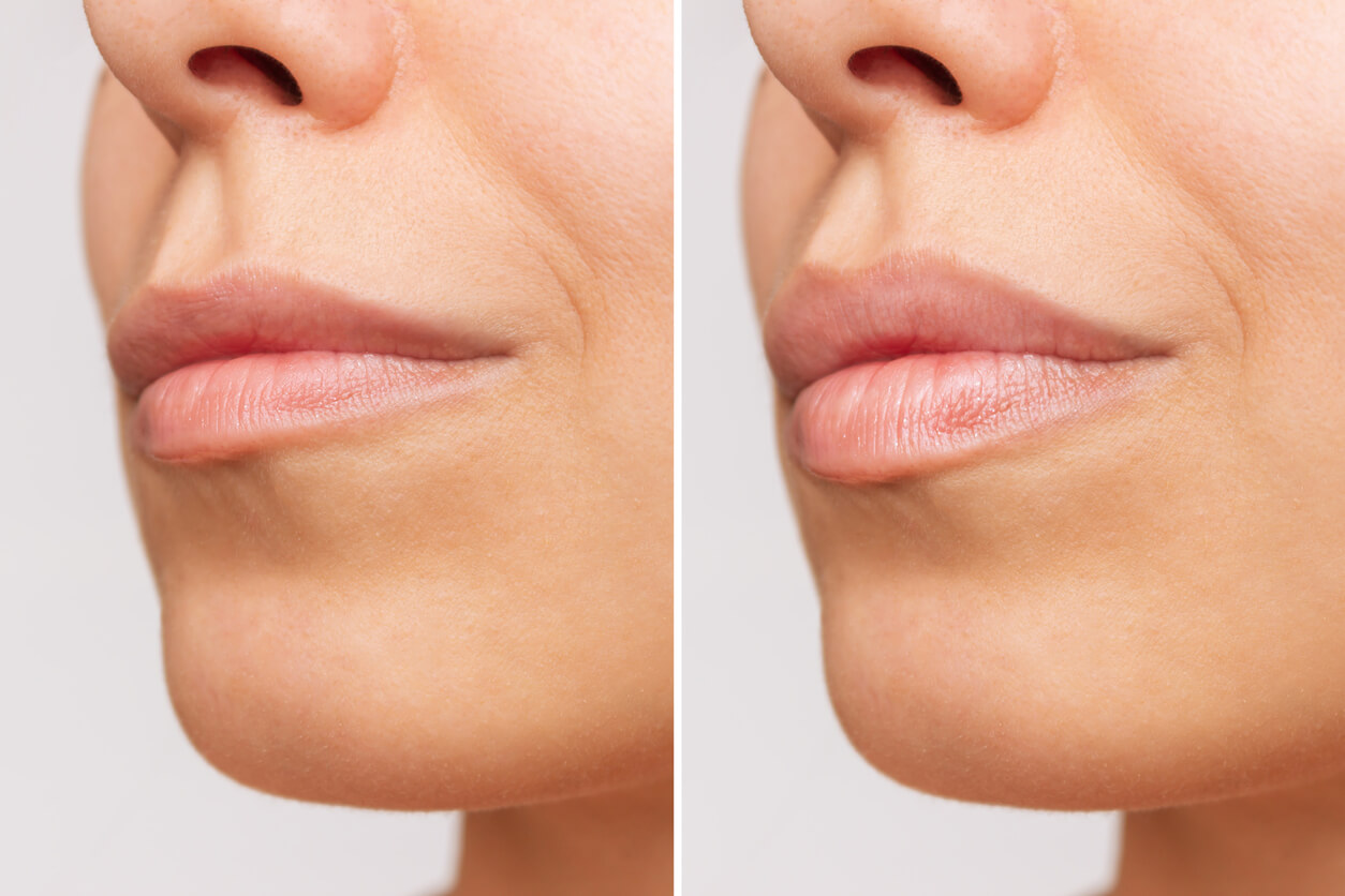 How Do You Start with Lip Fillers Treatment in Bolton