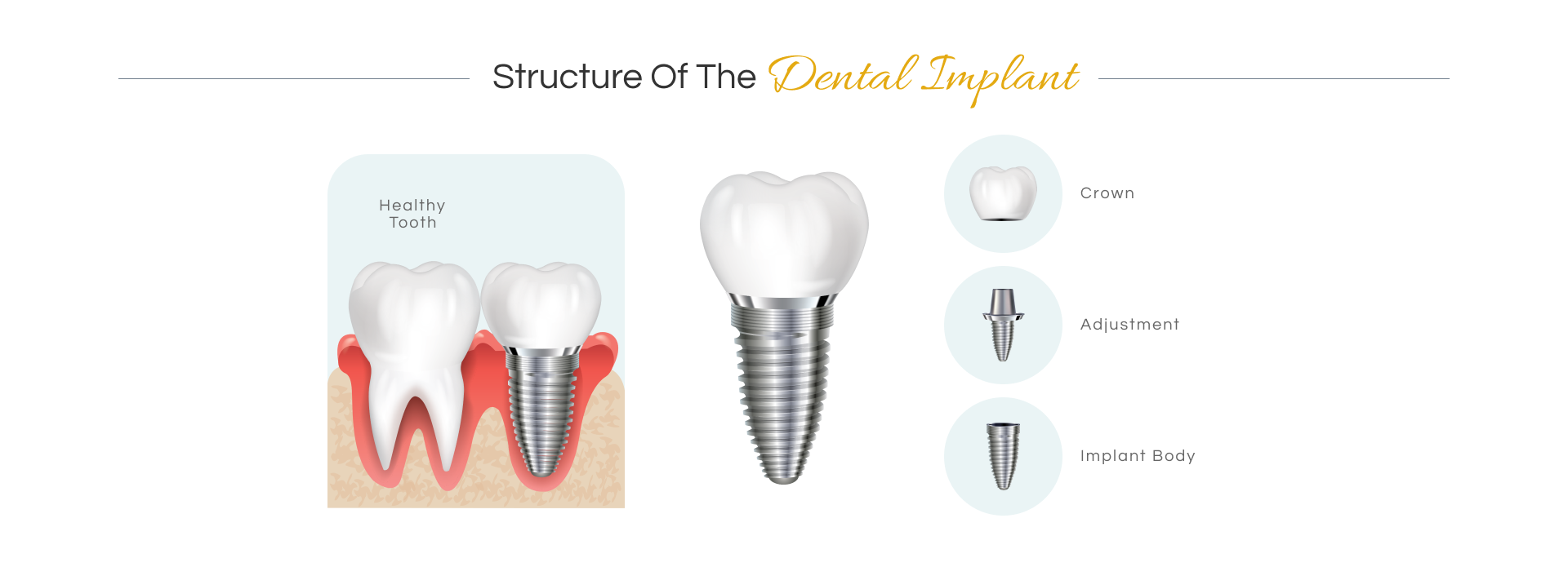 What is Dental Implant